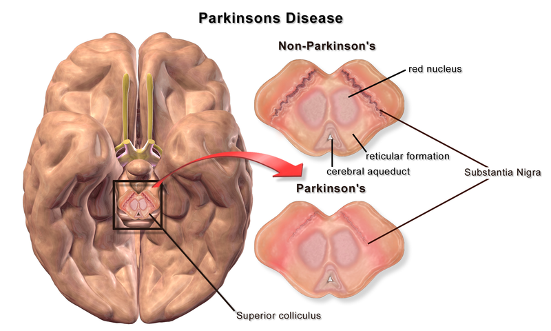 Effective Solutions for Parkinson's Disease Neuro Rehab in the UK