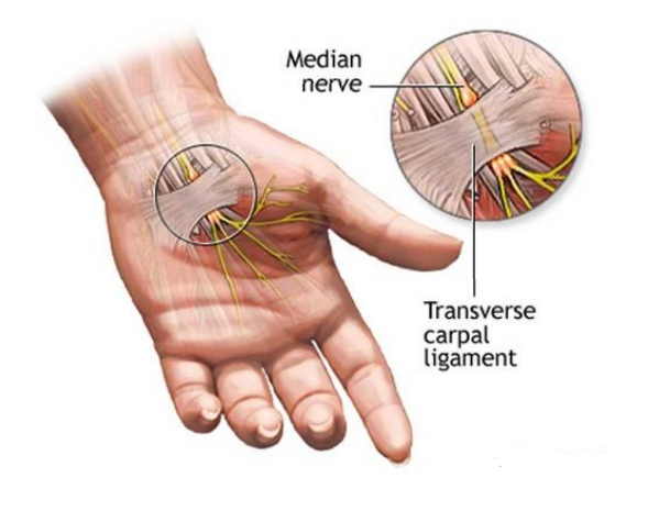 Carpal Tunnel Syndrome (CTS)
