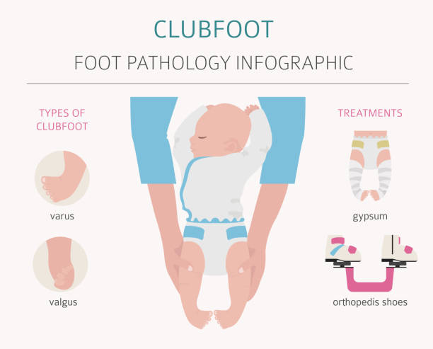 Discover expert care for Clubfoot (Congenital Talipes Equinovarus) at PhysioElm UK. Tailored physiotherapy supports mobility & enhances quality of life.