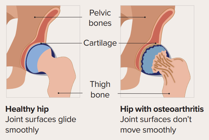 Hip Osteoarthritis : Hip joints have a smooth cushioning substance called cartilage, between the pelvic and thigh bones. Osteoarthritis is when this cartilage becomes thin, the joint is damaged and it can not move easily. Your body tries to repair the joint. Sometimes this repair does not work well which results in pain, stiffness and swelling. Most of us will get some osteoarthritis in our joints as we age but it doesn’t always cause pain.