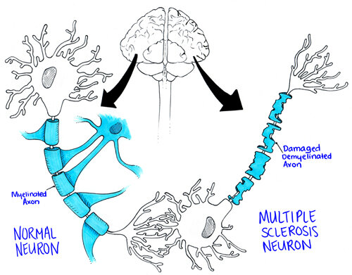 Multiple Sclerosis Neuron
