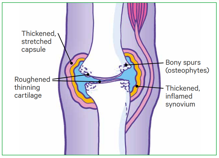 Osteoarthritis: Joint Affected by Osteoarthritis