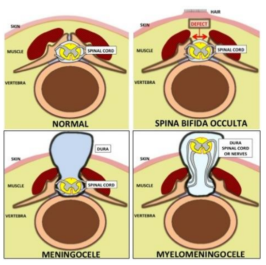 Spina bifida can be caused by a deficiency in folate (a water -soluble vitamin found in green leafy vegetables), a problem with the baby’s chromosomes or by a genetic disorder. If so, the baby may haveadditional medical problems or organ abnormalities. Spina bifida that occurs by itself and without any identifiable cause is called isolated spina bifida. Because of the range of associated conditions, it is important that spina bifida is thoroughly investigated in order to provide an accurate assessment on the likely effect on the baby. 