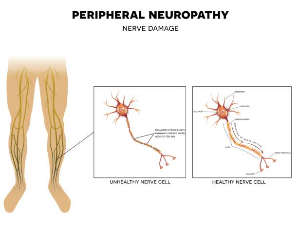 Discover effective solutions for managing peripheral neuropathy and diabetes. PhysioElm offers expert care tailored to enhance mobility and well-being in the UK.