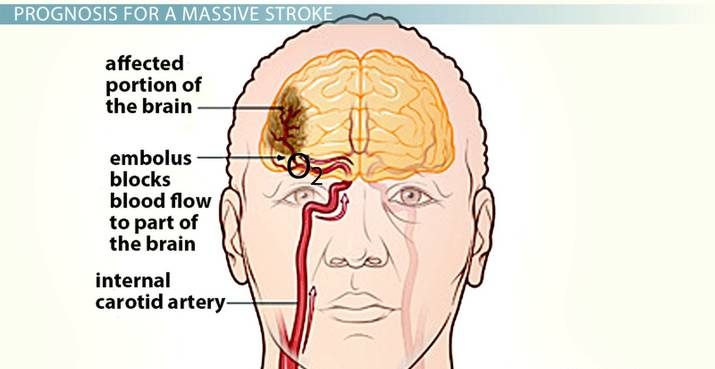 Recover from stroke with expert neuro rehab. Improve mobility, strength, and independence with PhysioElm's stroke recovery physiotherapy. Book a consultation today.