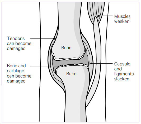 Discover expert care for rheumatoid arthritis in the UK. Learn about symptoms, causes, treatments, and how PhysioElm's physiotherapy services can ease your journey to relief.